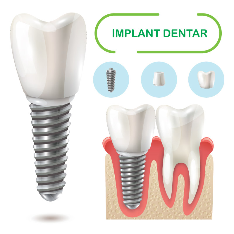 Implantul dentar Implant dentar