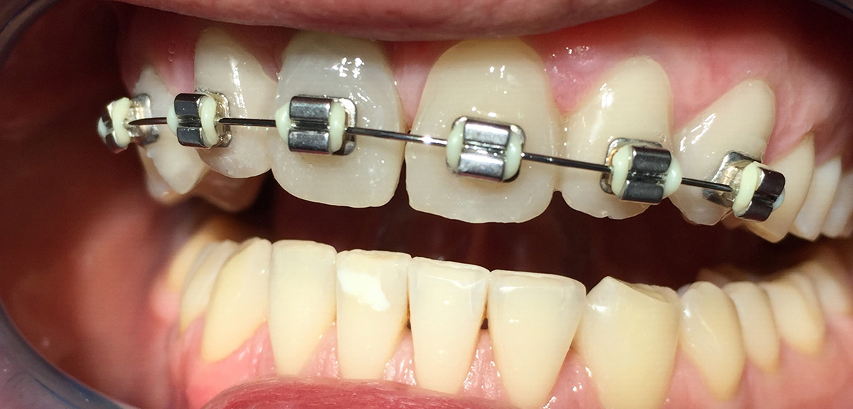 Tratament coroane temporare